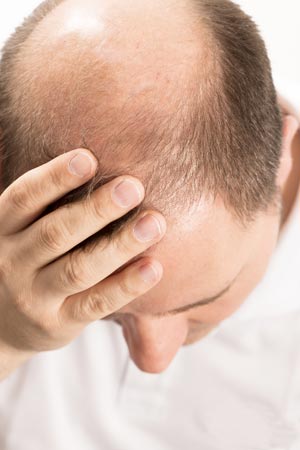 Hyperinsulinemia and Men's Health: Is There a Male Equivalent to PCOS?